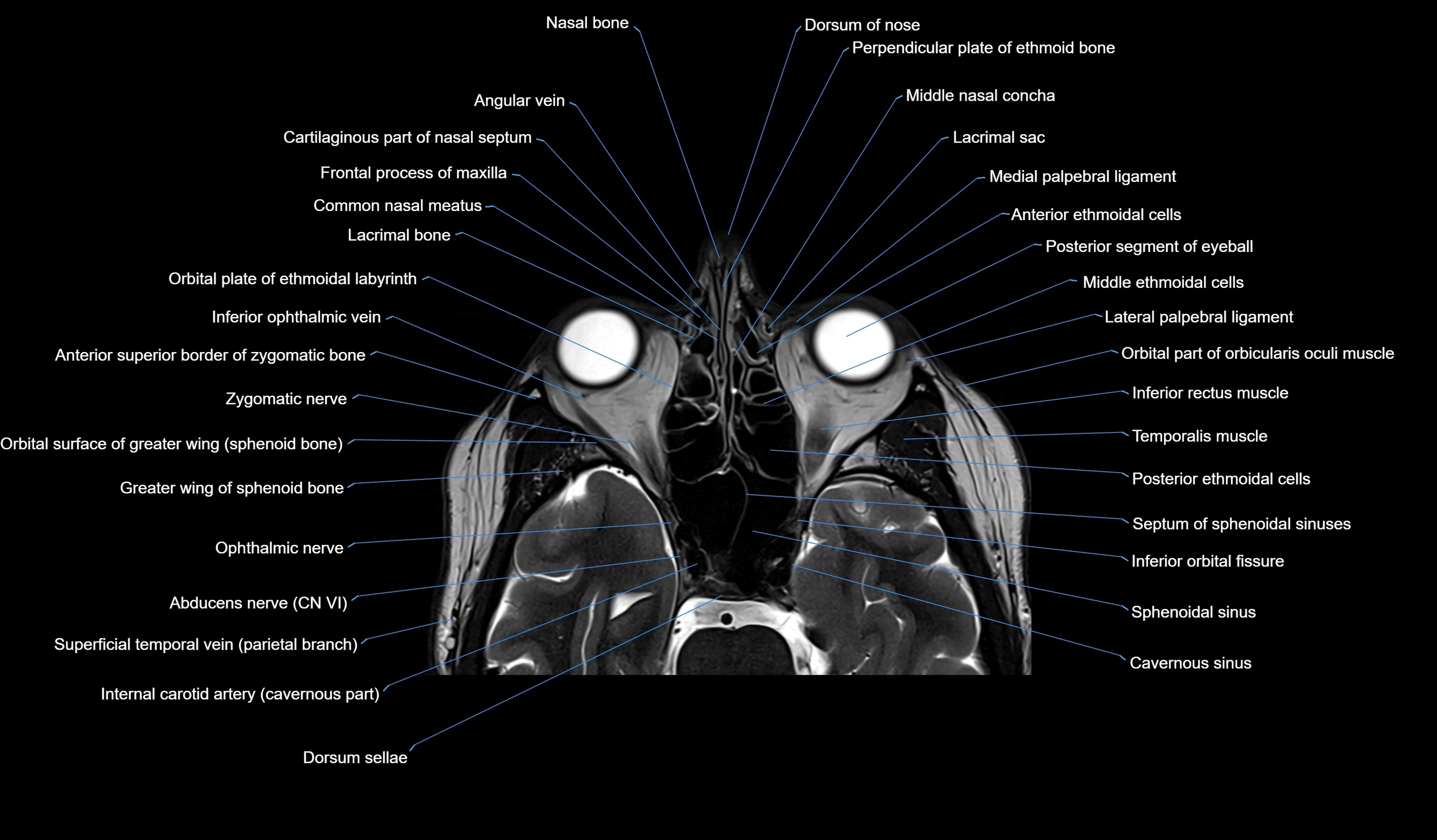 MRI face & paranasal sinuses(PNS) labelled  axial  cross sectional anatomy 3T radiology  image -00019.webp